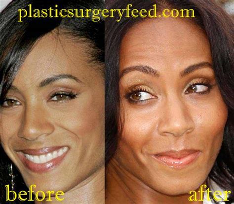 Jada Pinkett Smith Plastic Surgery Plastic Surgery Feed