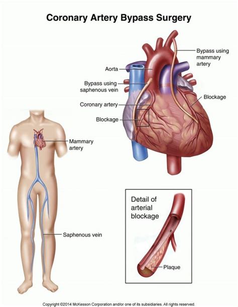 Coronary Artery Bypass Graft Surgery Cabg Cardiovascular
