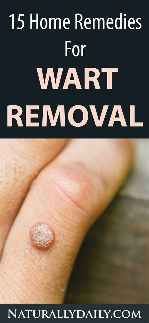 15 Home Remedies For Warts Easy Home Wart Treatments Vixohealth