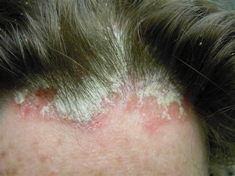 What Does Scalp Psoriasis Look Like Symptoms And Pictures