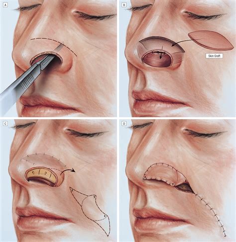 Reconstruction Of Nasal Alar Defects Jama Facial Plastic Surgery