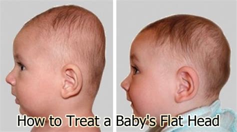 How To Treat A Babys Flat Head