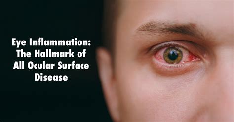 Eye Inflammation The Hallmark Of All Ocular Surface Disease Inflammation Ocular Disease