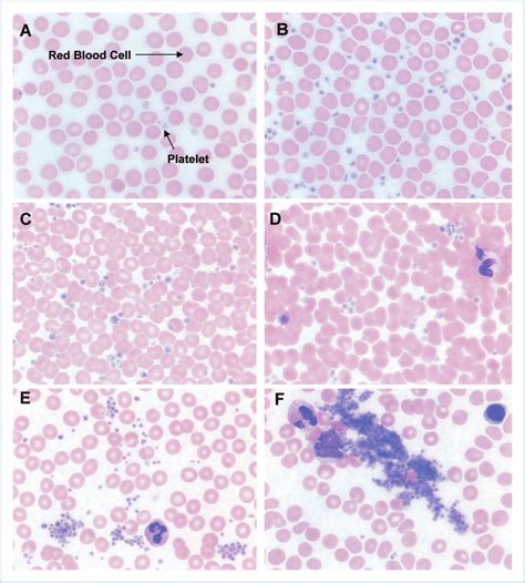 The Morphology Of Platelets In Platelet Rich Plasma Prp Change As A