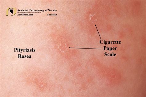 Pityriasis Rosea It Starts With A Herald Patch Academic