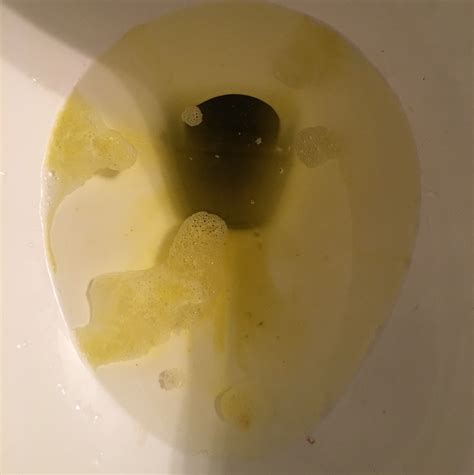 Yellow Vomit Toddler Hiccups Pregnancy