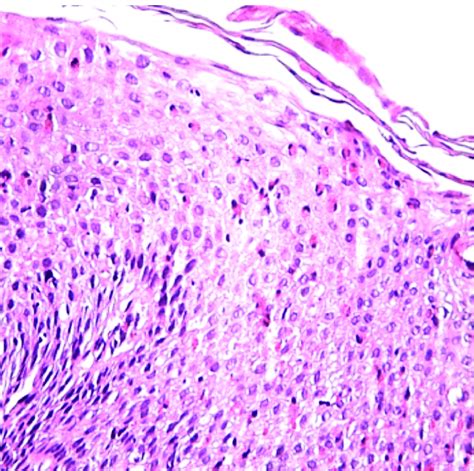 Marked Intraepithelial Eosinophilia And Eosinophilic Microabscesses