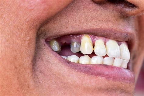 Single Tooth Removable Valplast Denture