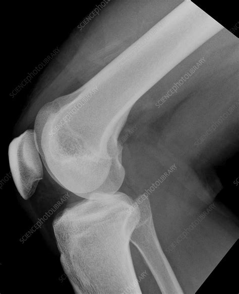 Normal Knee X Ray Stock Image C0393310 Science Photo Library