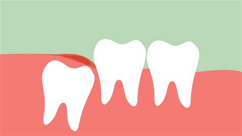 Inflammation Of Wisdom Tooth Angular Or Mesial Impaction Dental