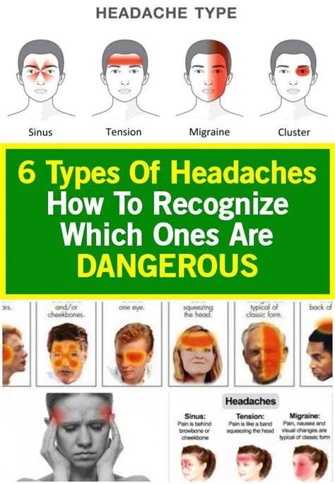 Types Of Headaches How To Recognize Which Ones Are Vrogue Co