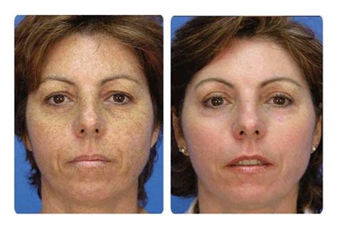 Microdermabrasion Before And After Mint Spa