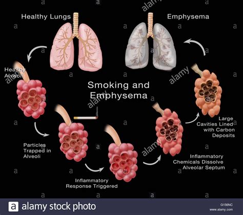 Stages Of Lung Damage Of A Smoker Leading To Emphysema The