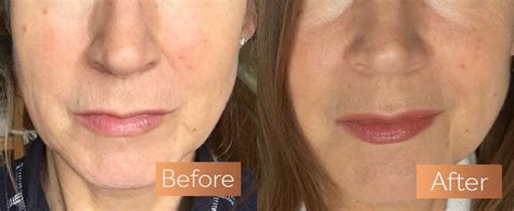 Absolute Collagen Before And After Pictures Incredible Results