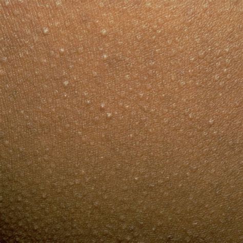 A Guide To Raised Bumps On Your Skin Red Moles Brown
