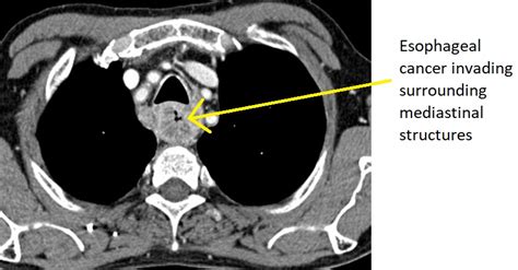 Esophageal Cancer Ct Wikidoc