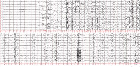 Jle Epileptic Disorders Ictal Atrial Fibrillation During Focal