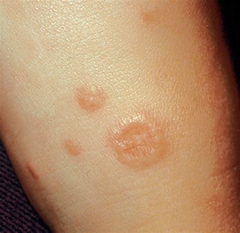 Granuloma Annulare Pictures