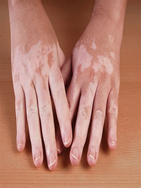 Vitiligo Treatment Mims Malaysia