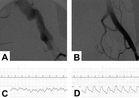 A Case Of External Iliac Arteriovenous Fistula And High Output Cardiac