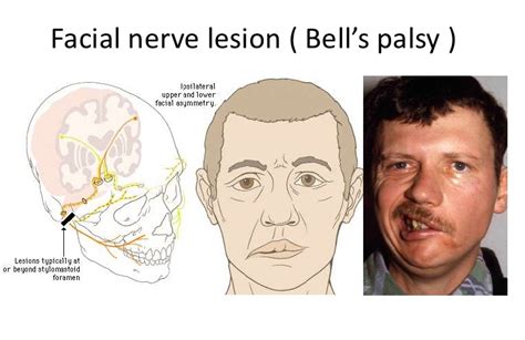 Bell S Palsy Causes Symptoms Diagnosis And Treatment Natural Health News