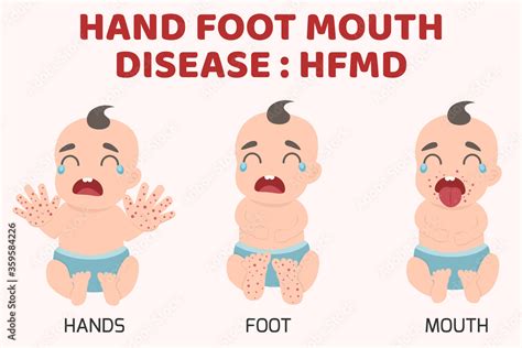 Hfmd Children Infected Hand Foot Mouth Disease Infographics With