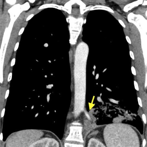 Transverse View Of The Ct Chest Showing Left Lower Lobe Consolidation