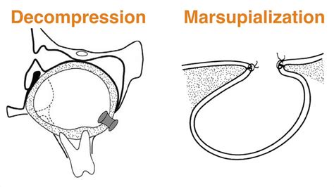 Decompression Or Marsupialization Technique For Managing Large