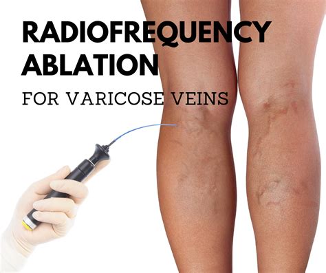 Radiofrequency Ablation For Varicose Veins Elite Vein Clinic