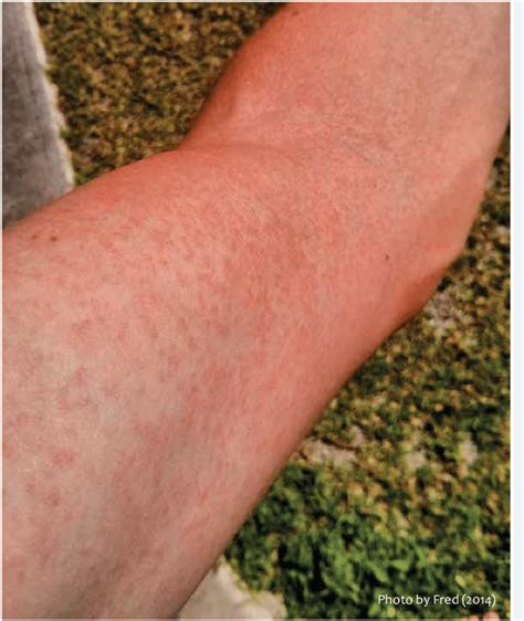 Papular Skin Rash On Arm A Common Symptom Of Zika Fever Download