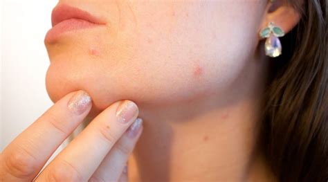 Acne Types And Symptoms Female Health Lab