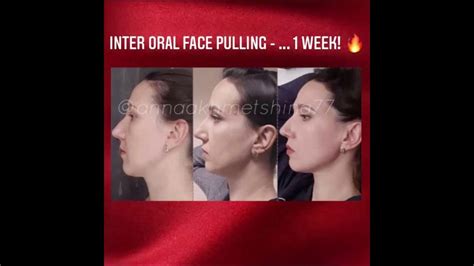 Inter Oral Face Pulling 1 Week Omg So Beautyfull Youtube