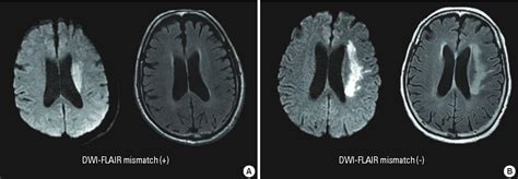 Figure 4 From Magnetic Resonance Imaging In Acute Ischemic Stroke