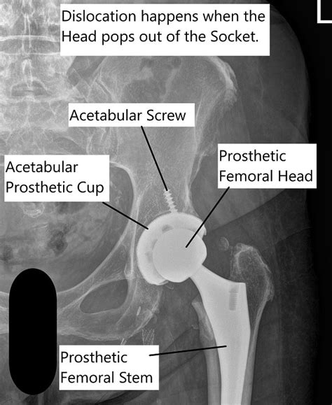 Dislocation Following Total Hip Replacement Causes And Cures Raymundoroegner