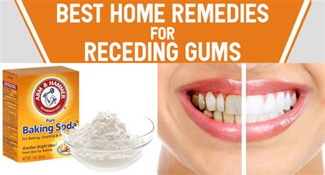 Best Home Remedies For Receding Gums Remedies Lore