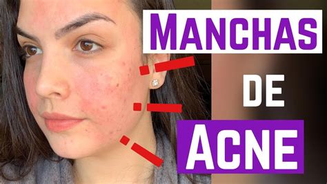 4 Produtos E Tratamentos Para Acabar De Vez Com As Manchas De Acne