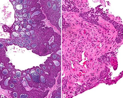 Adenoid Cystic Carcinoma With Squamous Differentiation And Variant