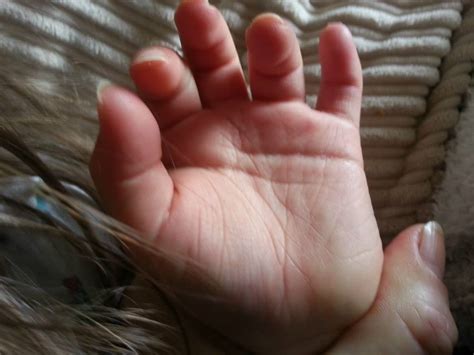 Hands And Palmar Creases In Children With Downs Syndrome Future Of