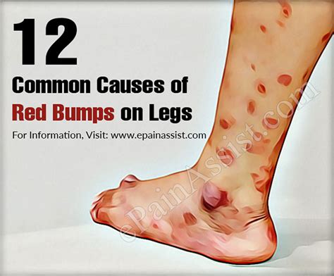 Common Causes Of Red Bumps On Legs Treatments To Get Rid Of Them