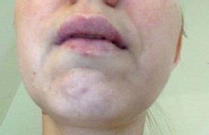 It does not have any puss, i touched it. Swollen Upper Lip Causes And Treatment - WOW Remedies