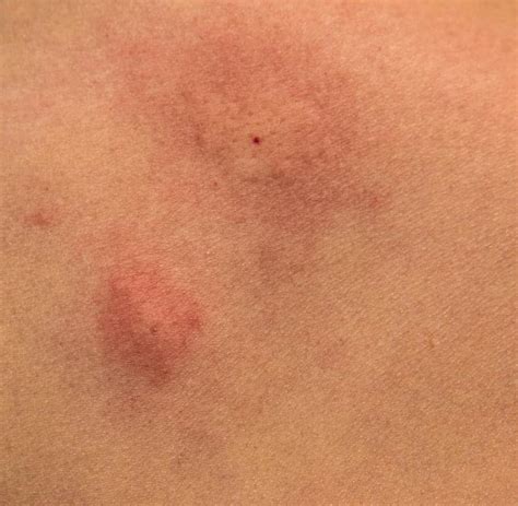 Mosquito Bites Pictures