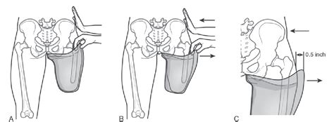 Figure 1 From Transfemoral Amputation Prosthetic Management