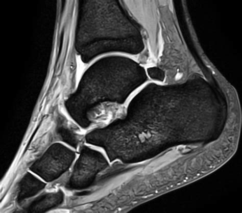 Lateral Ankle Sprain Diagnosis Mri Online