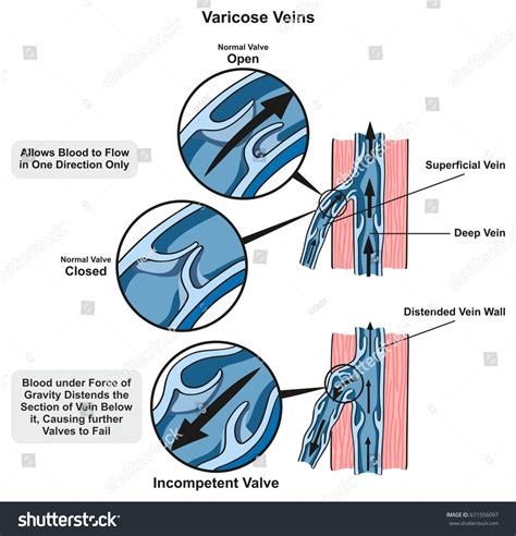Varicose Veins Infographic Diagram Showing Normal Stock Vector Royalty