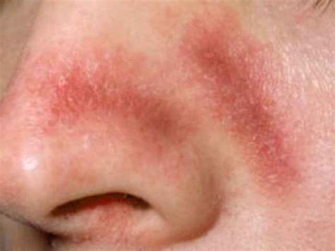What Is Red Blotchy Skin Pictures Causes And How To Treat