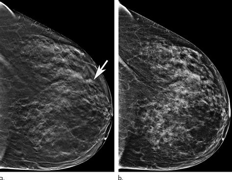 Older Women Benefit Significantly When Screened With 3 D Mammography