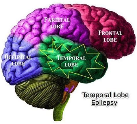 ¿qué Es La Resección Del Lóbulo Temporal Para La Epilepsia Cirugía De