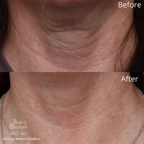 Injectable Fillers Before And After Brian Biesman Md