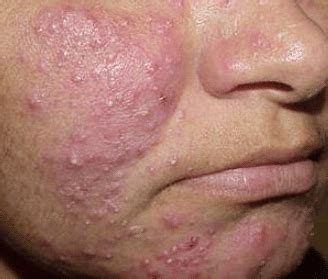 Heat Rash On Face Pictures Baby Bumps Causes Symptoms How To Get My