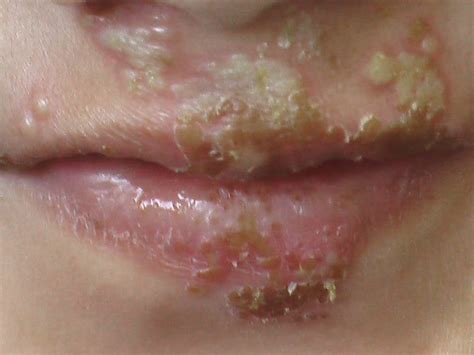 こどもの病気・おとなの病気:2012年11月